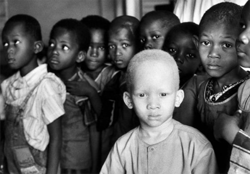 Exposition Etre albinos en Afrique de Bettina Clasen